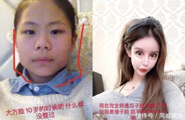 16岁女生整容60次花费过百万割双眼皮、隆鼻、磨骨变做人形芭比