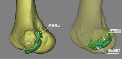 手术|用蚕丝做骨钉！骨折手术内固定开启新时代