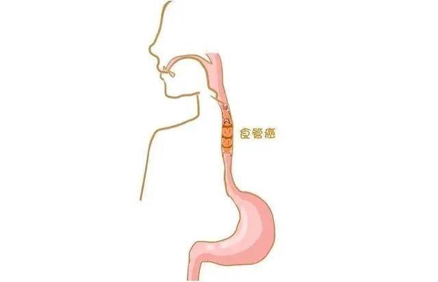 潮汕|喜欢喝热茶！食管癌找上62岁潮汕大叔