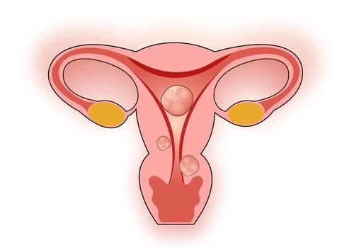 b超检查|子宫肌瘤一定要切除吗？切除后为何容易复发？看看医生怎么说