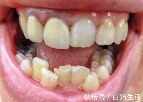 牙齿|孩子换牙齿,新长的牙齿却是歪的,可能是家长这些没做好