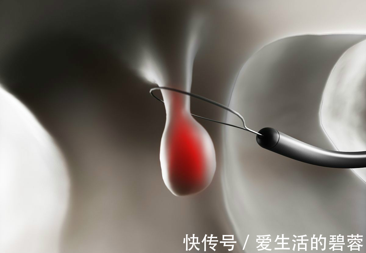 腺瘤性息肉|两种息肉一定要及时切除,拖的太久会变成进展期癌症