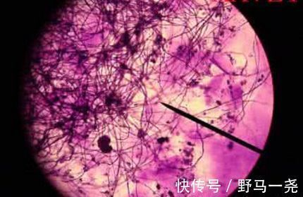 灼热感|皮肤出现3个信号,警惕糖尿病“恶化”!做好2点,远离并发症