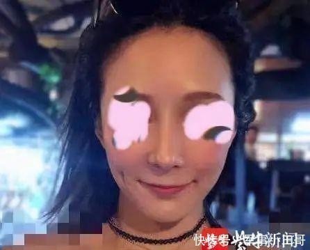 女子整容后山根晃动、鼻尖发白!手术方:很成功,已起诉