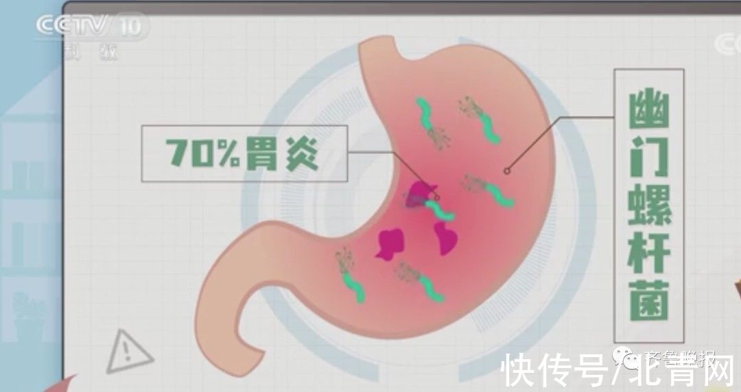 体检|它被列为“明确致癌物”！许多人体检都做过这项检查