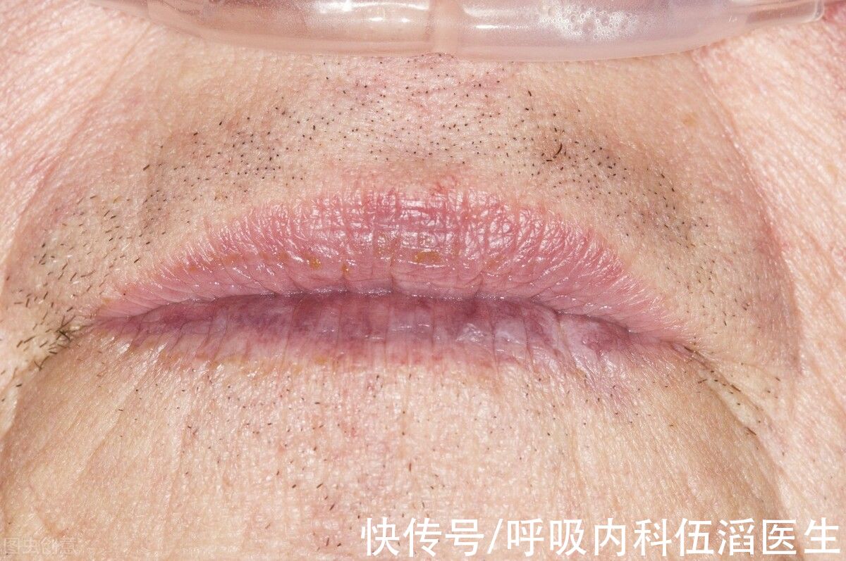 丈夫|肺癌“元凶”已找到,医生提醒:脸上有4种迹象,或是肺扛不住了