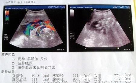 陈女士|女子肚大如球以为是怀了2个,剖宫产原来一个是惊一个是喜!