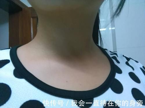淋巴液|体内有肿瘤,看脖子就知道?脖子有这2种“迹象”,说明出问题了