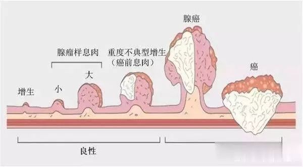 小丽|不便秘不腹泻，32岁女子突然便血，一查竟是肠癌