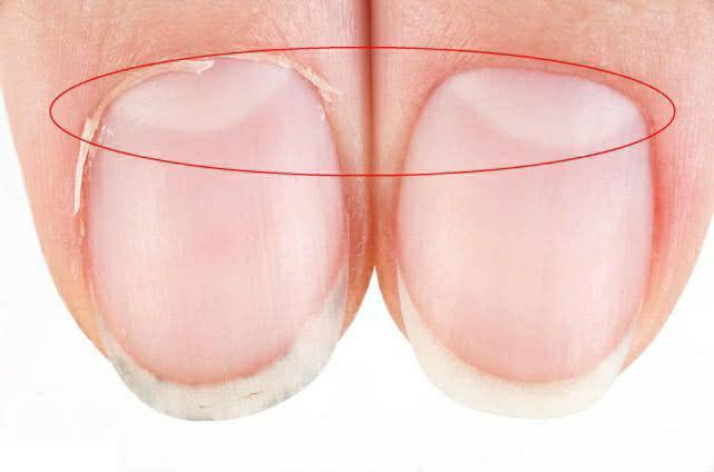 科学|指甲上没有月牙与指甲上有的人,谁身体更健康科学的解释来了