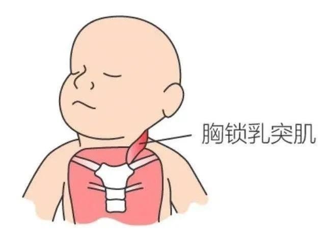 胸锁乳突肌挛缩|这种可爱的“歪头杀”不要也罢