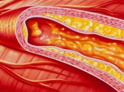 甘油三酯|甘油三酯“害怕”一物,不是大蒜,水里放一勺,血脂乖乖下降