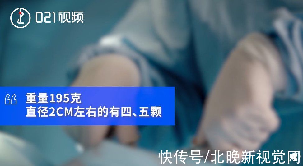 男子|可怕！上海一男子膀胱藏近200颗石子，取出耗时1个多小时