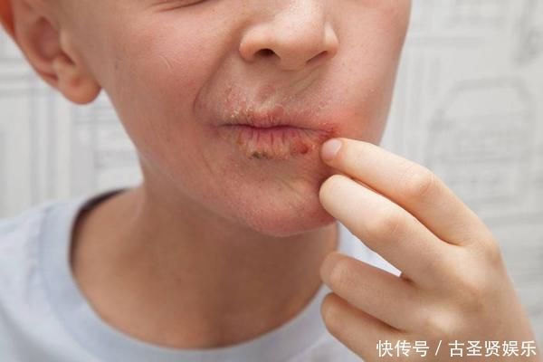 维生素b|嘴唇总是干燥的原因找到了,除了缺水,第四个你应该没想到