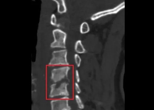 颈椎结核|因为这......她的两节颈椎被“吃掉”,差点瘫痪!