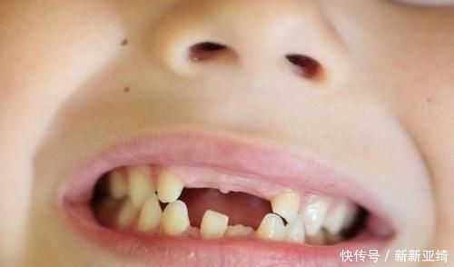 孩子“乳牙”脱落别着急扔,关键时刻能救命不懂为啥尽快了解下