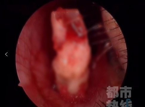 失踪|一6岁女童鼻子里“长牙”,取出后发现竟是三年前失踪的门牙