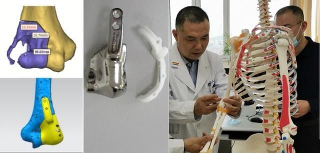 个性化、精准化，烟台山医院将3D打印技术应用于骨肿瘤手术