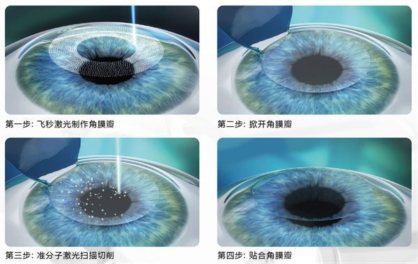 林顺潮|林顺潮眼科医院：到底是换眼镜划算还是做个近视手术划算？