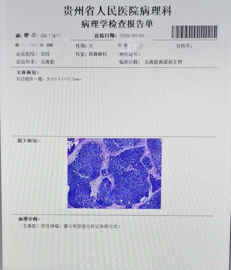 吴女士|眼科治了14个月,最后查出鼻咽癌!医生提醒:有4个症状要小心