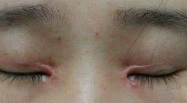 美女|曾经那些割了双眼皮的美女,10年后会变啥样,看完还敢割吗?