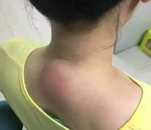 纱布|“十个颈椎九个包”,厨房中拿瓶醋,此法能治好,早知早受益