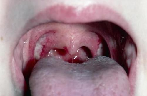 扁桃体结石是如何形成的 扁桃体结石有哪些症状 快资讯 扁桃体结石是如何形成的 扁桃体结石有哪些症状 快资讯