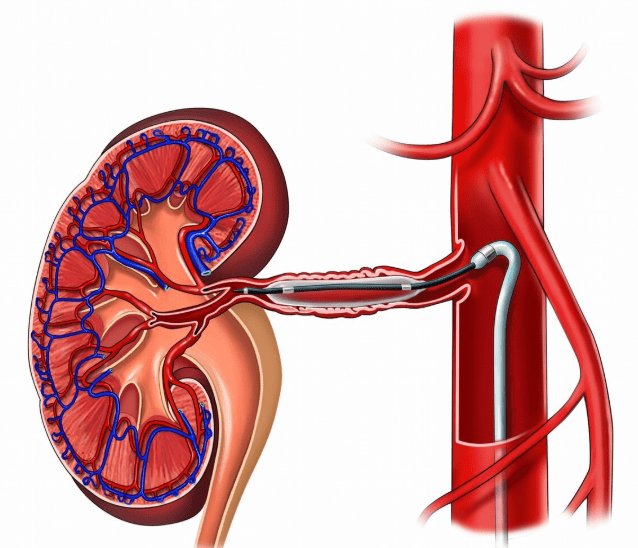 肾小球|肾病如何避免反复，治疗一步到位？严防肾衰竭，4个关键点要稳