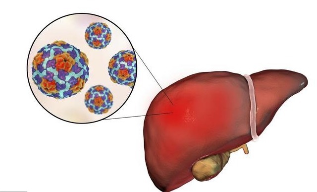 肝脏|肝脏不好的人，身体会有''1处疼、4变色''，做好4件事，远离肝癌