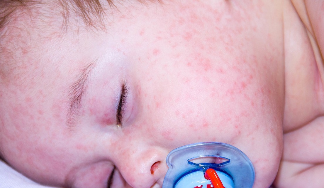 豌豆|新生儿宝贝长了好多湿疹,什么原因,2招教你快速搞定
