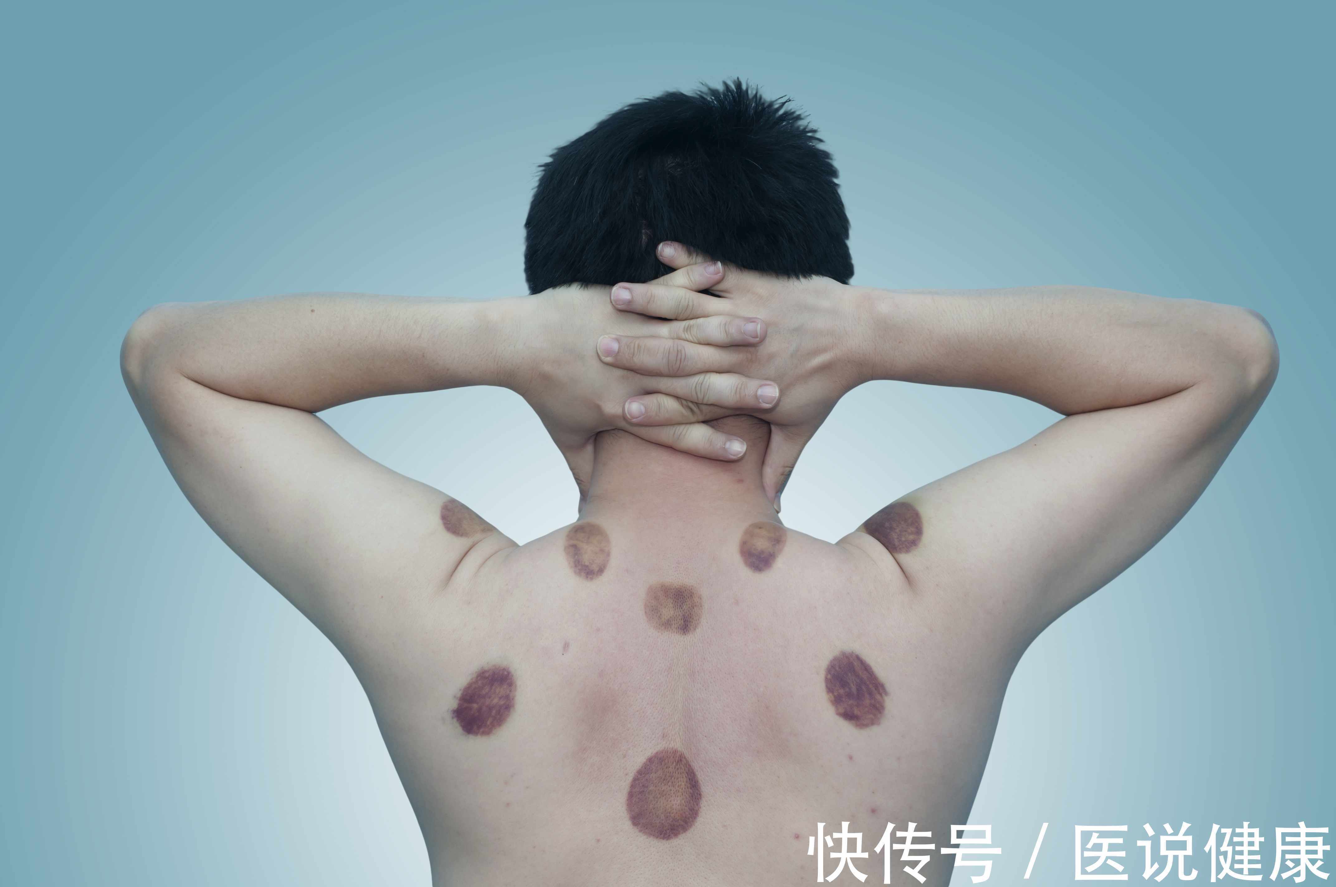 寒湿|寒湿体质的人,身上有这6个特征表现,若你有,趁早调理