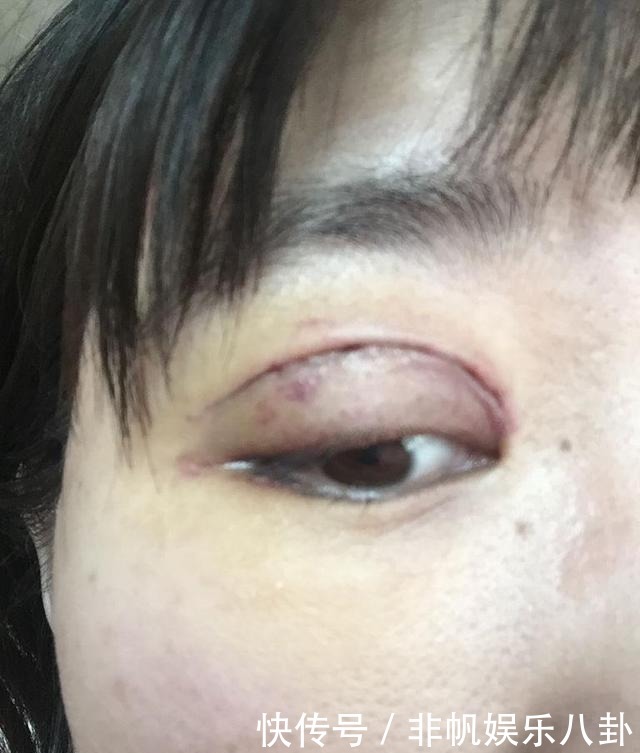 维权|劝你别割“双眼皮”,整容师透露3点,割过的人很后悔