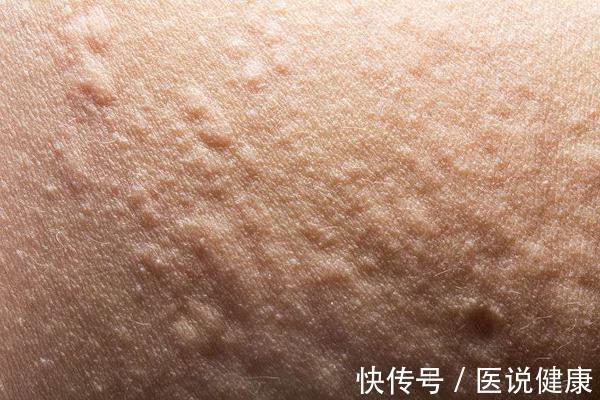 皮肤|糖尿病患者,可能会出现6种皮肤病变,发现后,及时控制血糖