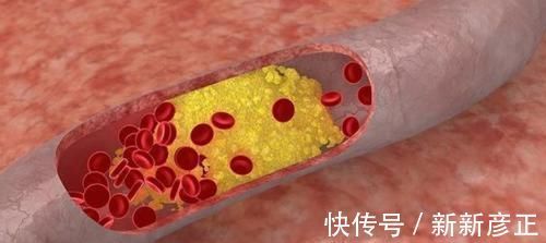 高脂血症|甘油三酯高,吃3物,坚持1个月,血脂降到1.2,血管垃圾一扫光