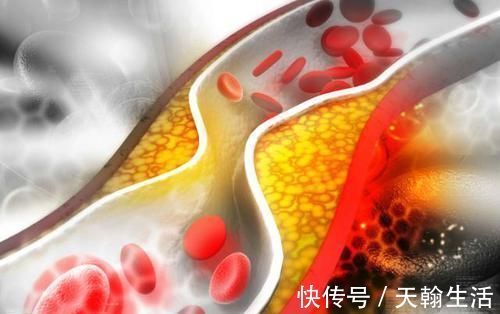 血管|当手上有这4个信号,表示血管堵塞很严重,要及时治疗