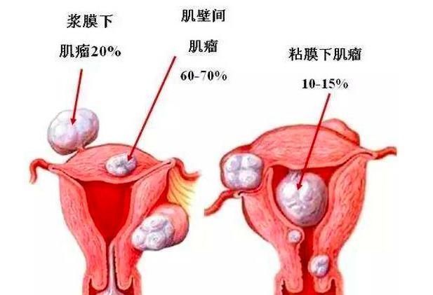 粘膜下肌瘤|遇到子宫肌瘤一定要切吗?4种方法可以让子宫肌瘤自行缩小