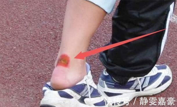 甲状腺功能减退|脚部有“4症状”,是“大病”在提前通知你,医生需尽早就医