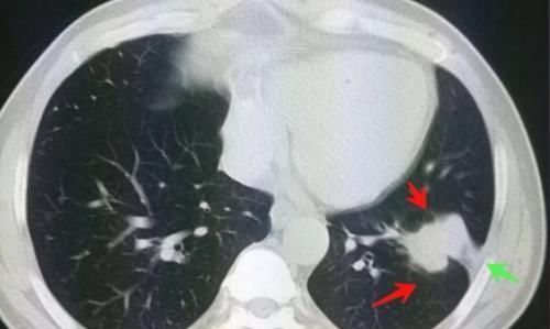 肺结节|癌症病人的幸运指数不一样,这位老太太想感谢一个吹破的肺大泡