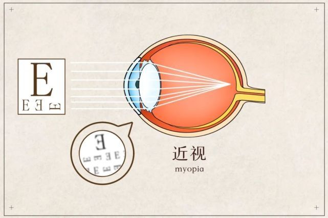 睫状肌|经常转眼球可以降低度数吗？关于近视，这里有一个残忍的真相…