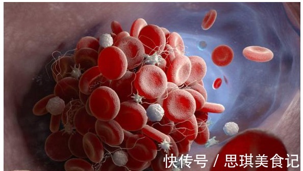 疏通血管|脑供血不足,头晕迷糊,忌食2物,多喝2水,血不稠血管或能通