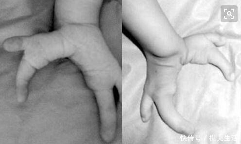 畸形|胎儿“龙虾手”因辐射导致生活中这些电器辐射对胎儿有影响吗?