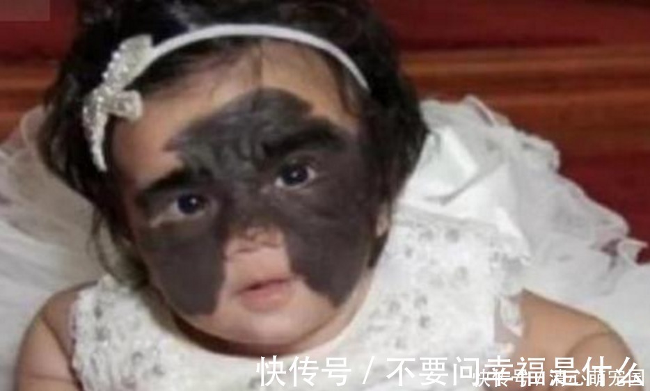 整容|女婴一出生伴随“蝙蝠侠印记”,被父母送去整容7次,结果怎样了
