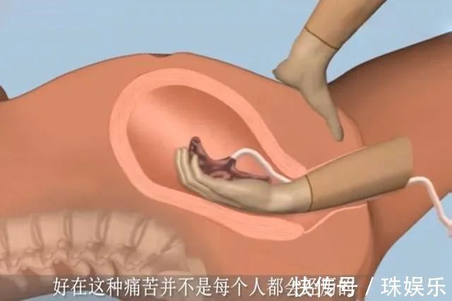 宫缩|为什么有些产妇生完孩子后,胎盘不能自动娩出,还需要手剥胎盘