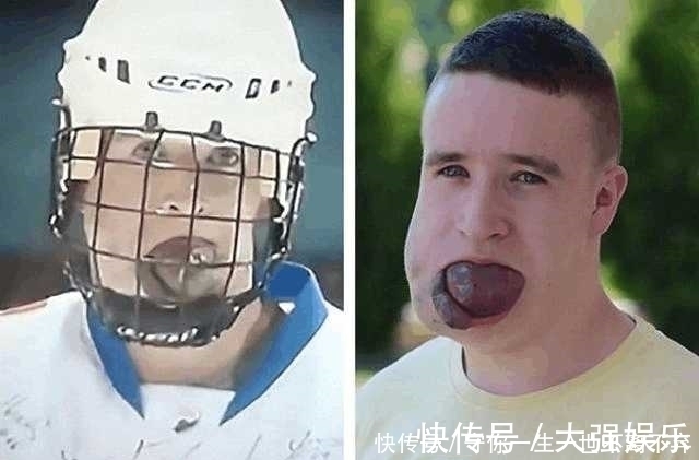 男孩|从小长着巨大舌头的男孩, 睡觉都可能窒息!