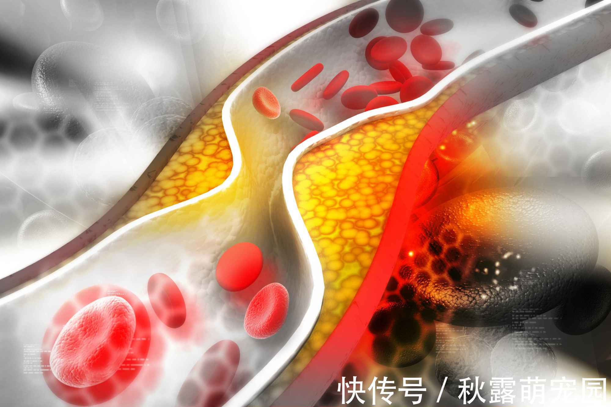 头痛|血管堵塞的人,身体3处会痛!医生支招:坚持“五个一”血液畅通