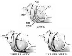 高血压|必须重视！您打鼾时，血压可能已经坐上“过山车”！