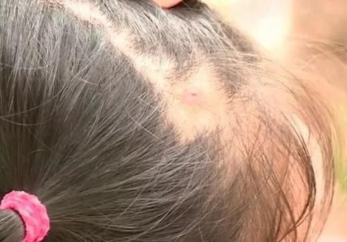 检查|爸爸给女儿梳头时发现“白米粒”,送医院后,检查结果让宝爸后怕