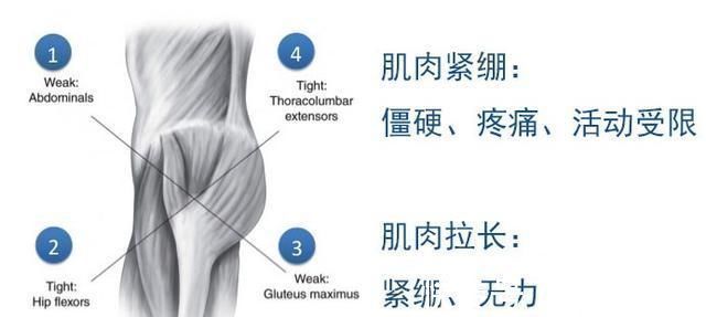 中立|“翘屁股”，我们真的需要它吗骨盆前倾危害大，9个动作纠正它