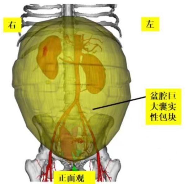 李晓姗|女子肚子突然增大！以为吃胖了，结果竟是长了……医生重要提醒
