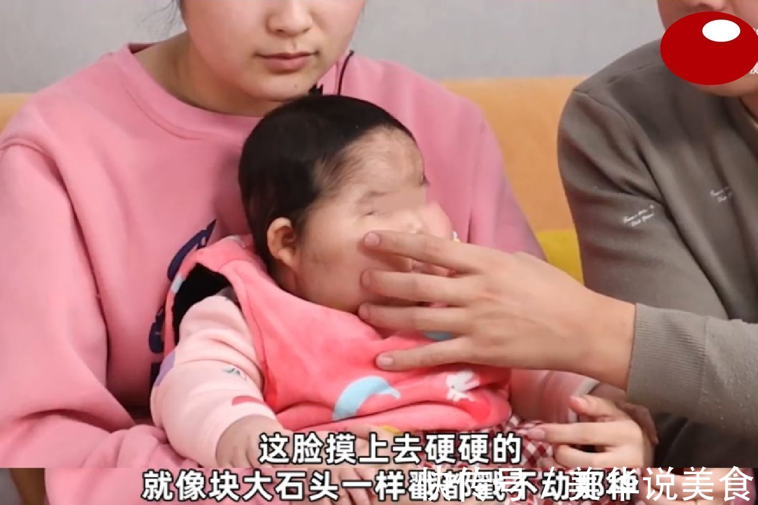 大头娃娃|“大头娃娃”再现,抑菌霜激素超标,致5个月女婴疯狂长胖长毛